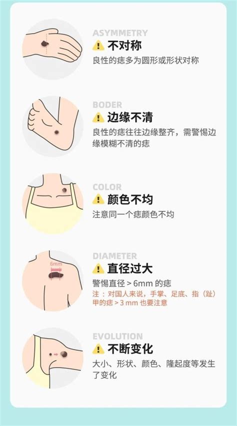 頭上有肉痣|痣也可能会癌变！长在 3 个地方要注意